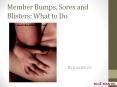 Member Bumps, Sores and Blisters: What to Do PowerPoint PPT Presentation