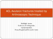 Arthroscopic ACL Acvulsion fixation