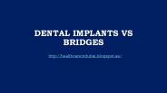 Dental Implants Vs Bridges