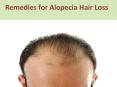 Remedies for alopecia hair loss causes cure treatments PowerPoint PPT Presentation
