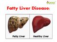 Fatty Liver Disease: Information on symptoms, causes and treatment PowerPoint PPT Presentation
