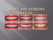 what are veneers teeth