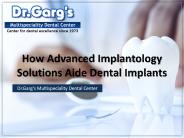 How Advanced Implantology Solutions Aide Dental Implants