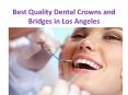 Dental crowns and bridges treatment PowerPoint PPT Presentation