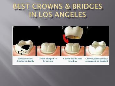 Best Crowns & Bridges in Los Angeles 3 july 17