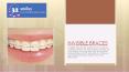 A PPT on Invisible Braces by Dr Milind Darda|32smiles PowerPoint PPT Presentation