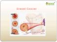 Breast Cancer : Overview of symptoms, causes, diagnosis, risk factor and treatment PowerPoint PPT Presentation