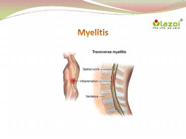 Myelitis : Overview, causes, types, symptoms, diagnosis and treatment