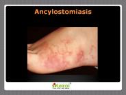 Ancylostomiasis - Symptoms, Treatments and Preventions