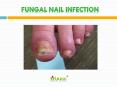 Fungal Nail Infection: Symptoms, Causes, Risk factors, Diagnosis, Treatment and Prevention PowerPoint PPT Presentation
