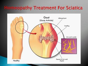 Homeopathy Treatment for Sciatica