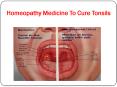 Homeopathy Medicine To Cure Tonsils PowerPoint PPT Presentation