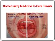 Homeopathy Medicine To Cure Tonsils