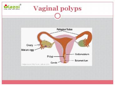Vaginal polyps : Causes, symptoms, diagnosis and treatment