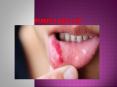Pimple on Lip 15 july 17 PowerPoint PPT Presentation