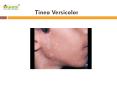 Tinea Versicolor: Symptoms, Causes, Diagnosis and Treatment PowerPoint PPT Presentation