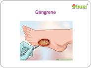 Gangrene : Overview, symptoms, causes, diagnosis and treatment
