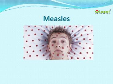 Measles: Causes, Symptoms, Complications and Treatment