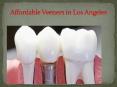 Affordable Veeners in Los Angeles17 july 17 PowerPoint PPT Presentation