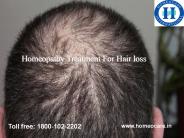 Get Effective Treatment For Hair Loss Using Homeopathy