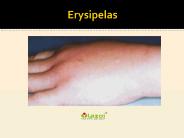 Erysipelas: Symptoms, Causes, Diagnosis and Treatment
