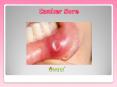 Canker Sore: Causes, Symptoms, Diagnosis and Treatment PowerPoint PPT Presentation