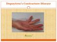 Dupuytren’s Contracture Disease: Causes, Symptoms, Diagnosis and Treatment PowerPoint PPT Presentation