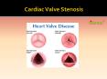 cardiac valve stenosis : Symptoms, Types, Causes, Treatment and Diagnosis PowerPoint PPT Presentation