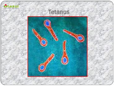 Tetanus : causes, symptoms, types, diagnosis, treatment and prevention