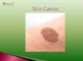 Skin Cancer : Overview, Symptoms, Causes, Sign, Risk Factor, Complication, Diagnosis and Treatment PowerPoint PPT Presentation