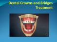 dental crowns and bridges treatment     25 july 17 PowerPoint PPT Presentation