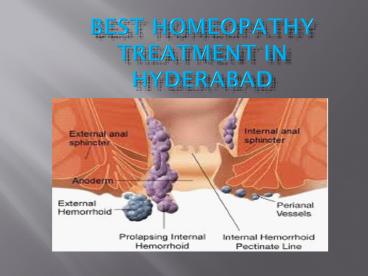 best homeopathy treatment in Hyderabad 25 july 17