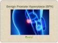 BPH (Benign Prostate Hyperplasia): Causes, Symptoms, and Treatment PowerPoint PPT Presentation