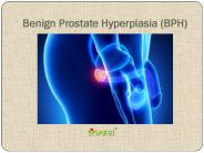 BPH (Benign Prostate Hyperplasia): Causes, Symptoms, and Treatment