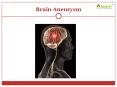 Brain Aneurysm: Causes, symptoms, diagnosis and treatment PowerPoint PPT Presentation