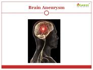 Brain Aneurysm: Causes, symptoms, diagnosis and treatment