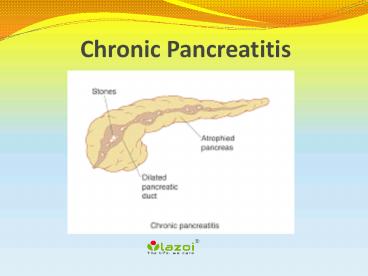 Chronic Pancreatitis: Causes, Symptoms, Diagnosis and Treatment of Chronic Pancreatitis