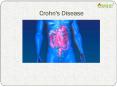 Crohn's Disease: Symptoms, Types, Causes Diagnosis and Treatment PowerPoint PPT Presentation