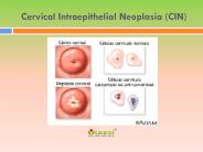 Cervical Intraepithelial Neoplasia (CIN): Symptoms, causes and treatment