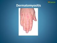 Dermatomyositis: What are its symptoms, causes and treatment
