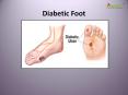 Diabetic Foot: Symptoms, Risks, Diagnosis, Treatment and Prevention PowerPoint PPT Presentation