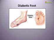 Diabetic Foot: Symptoms, Risks, Diagnosis, Treatment and Prevention