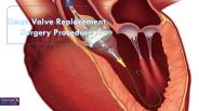 Heart Valve Replacement Surgery Procedure