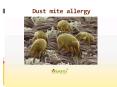 Dust mite allergy: General information on symptoms, causes and more PowerPoint PPT Presentation