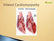 Dilated Cardiomyopathy