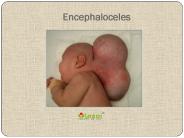 Encephaloceles: Symptoms, causes, diagnosis and treatment