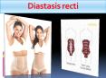 Diastasis recti PowerPoint PPT Presentation