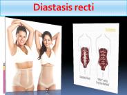 Diastasis recti