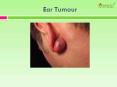 Watch Out? That ear pain may be a tumour PowerPoint PPT Presentation