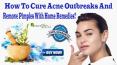 How To Cure Acne Outbreaks And Remove Pimples With Home Remedies? PowerPoint PPT Presentation